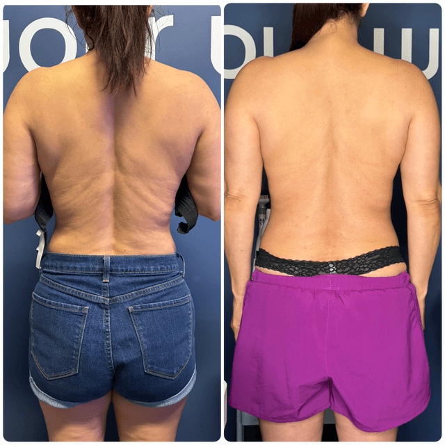 Cryoskin Slimming 5-Pack